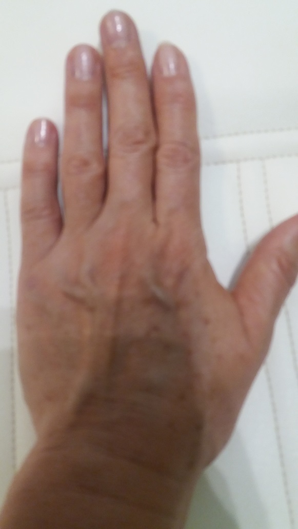Pikkelysömör és seborrhoeás dermatitisz